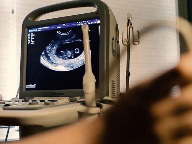 Sonogram Ultrasound